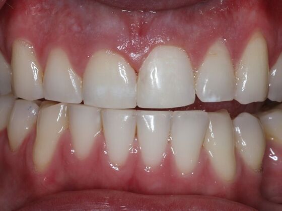 Dental Bonding Case 8 - After