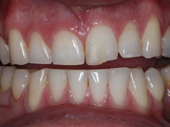 Dental Bonding Case 8 - Before