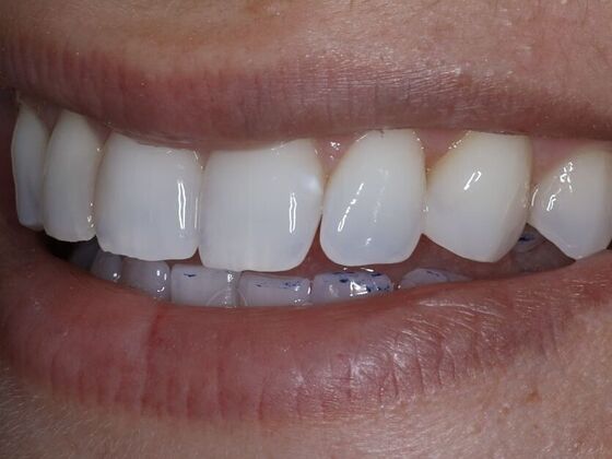 Dental Bonding Case 9 - After