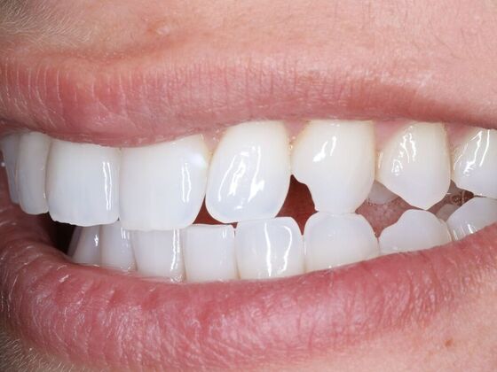Dental Bonding Case 9 - Before