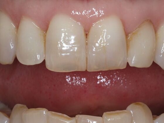 Dental Bonding Case 10 - Before