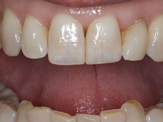 Dental Bonding Case 10 - After