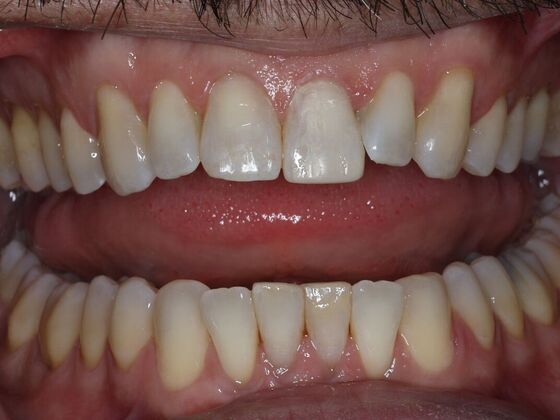 Dental Bonding Case 11 - After