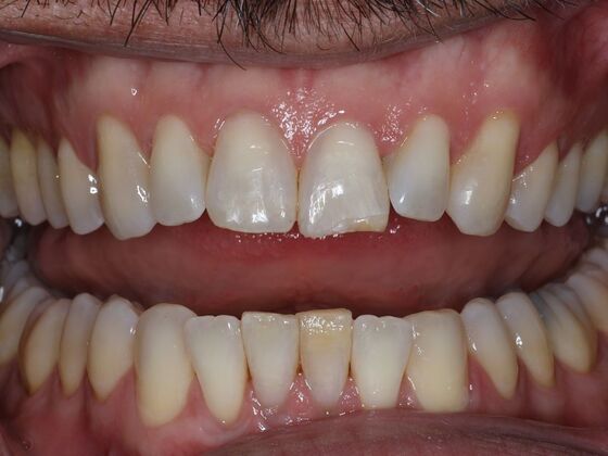 Dental Bonding Case 11 - Before