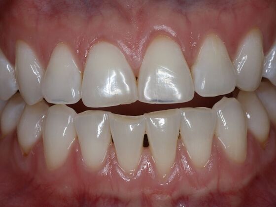 Dental Bonding Case 12 - Before