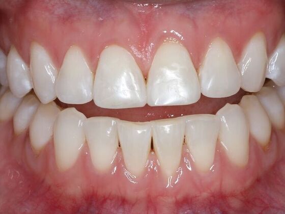 Dental Bonding Case 12 - After