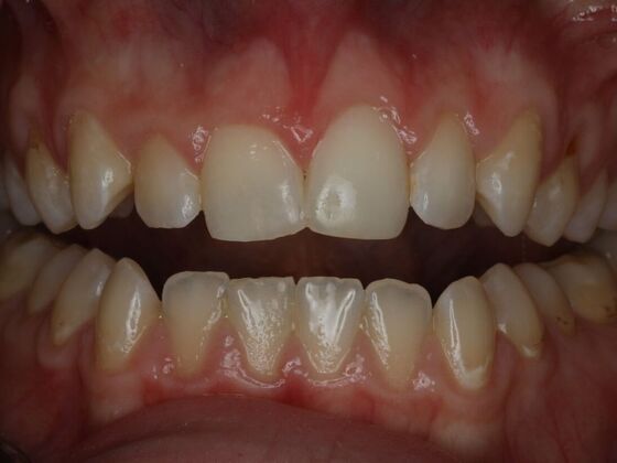 Dental Bonding Case 13 - After