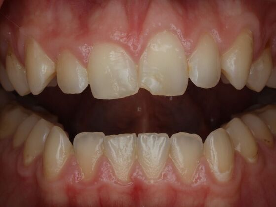 Dental Bonding Case 13 - Before