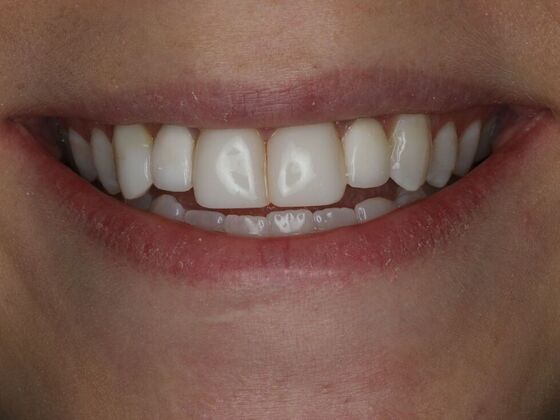 Dental Bonding Cases