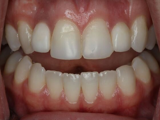 Dental Bonding Case 14 - Before