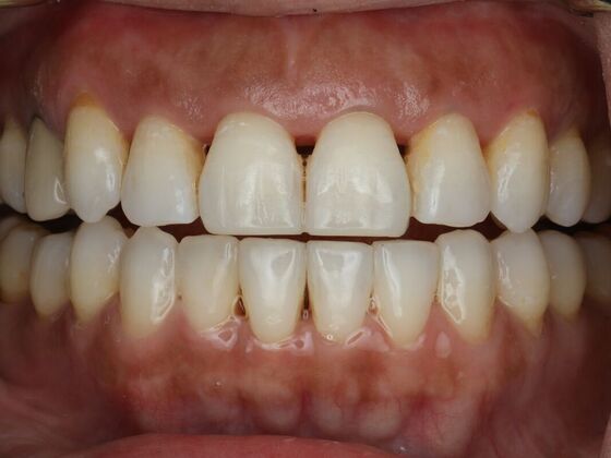 Dental Bonding Case 15 - After