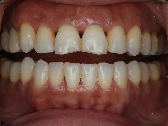 Dental Bonding Case 15 - Before