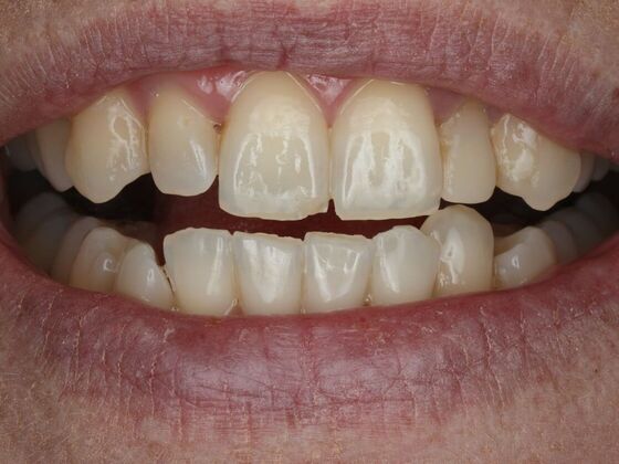 Dental Bonding Case 16 - Before