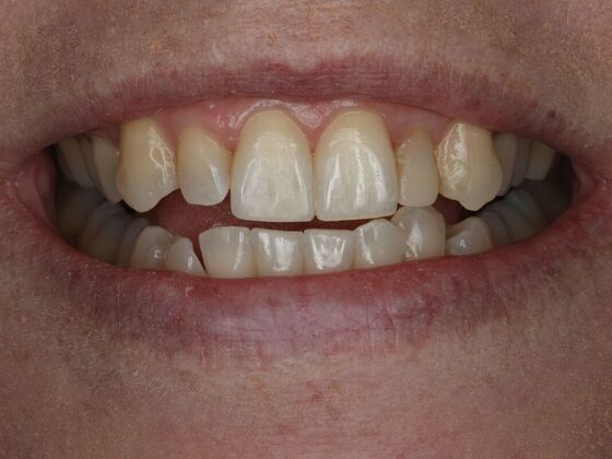 Dental Bonding Case 16 - After