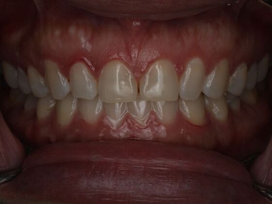 Dental Bonding Case 17 - Before