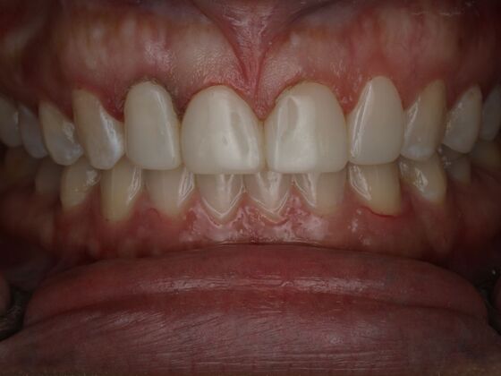 Dental Bonding Case 17 - After