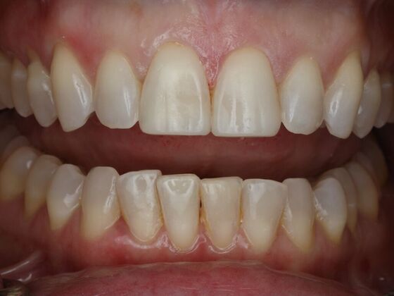 Dental Bonding Case 18 - After