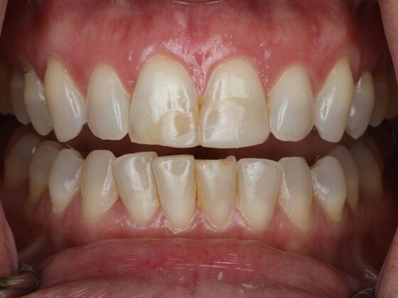 Dental Bonding Case 18 - Before