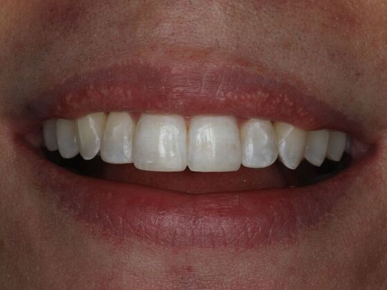 Dental Bonding Case 19 - After