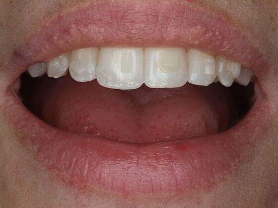 Dental Bonding Case 19 - Before