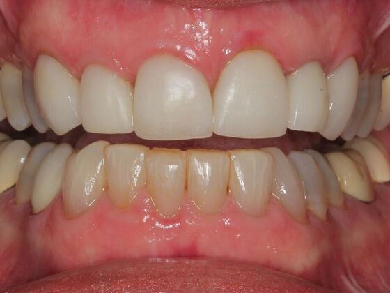 Dental Crowns Case 1 - Before