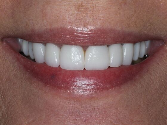 Dental Crowns Cases