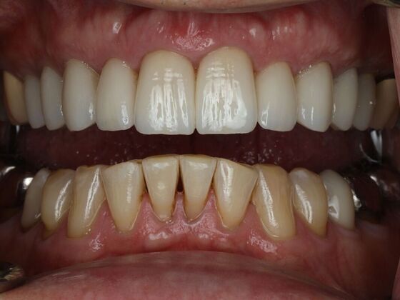 Dental Crowns Case 2 - Before