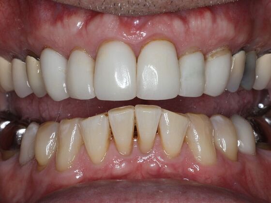 Dental Crowns Case 2 - After