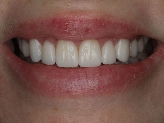 Dental Crowns Case 3 - After