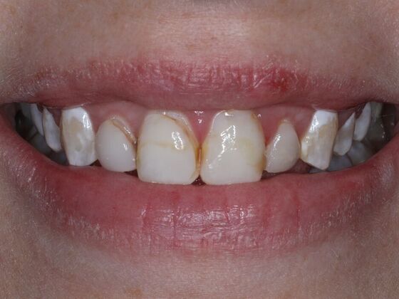 Dental Crowns Case 3 - Before