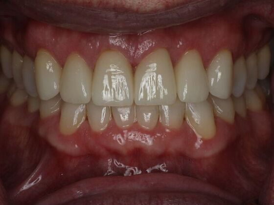 Dental Crowns Case 4 - After