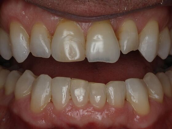 Dental Crowns Case 4 - Before