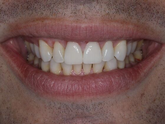 Dental Crowns Case 5 - After