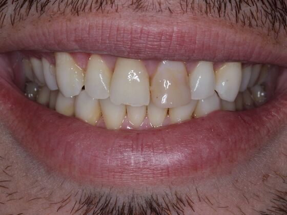 Dental Crowns Case 5 - Before