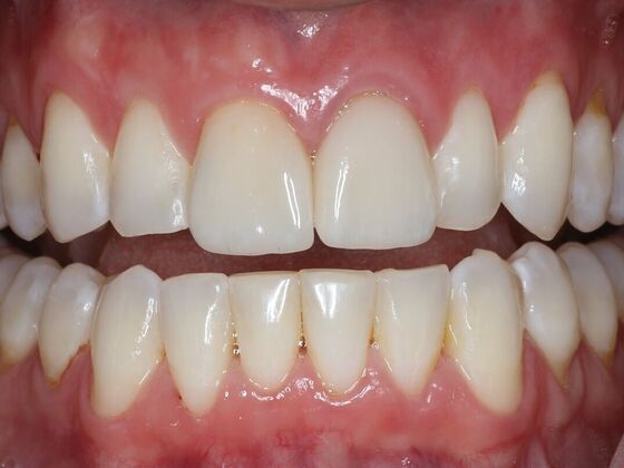 Dental Crowns Case 6 - After