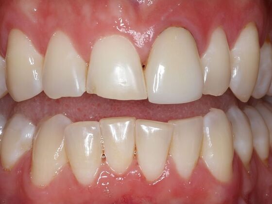 Dental Crowns Case 6 - Before