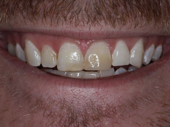 Dental Crowns Case 7 - Before