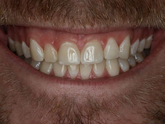 Dental Crowns Case 7 - After