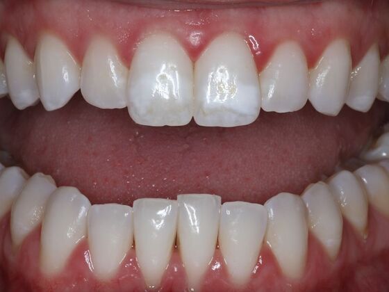 Dental Crowns Case 8 - Before
