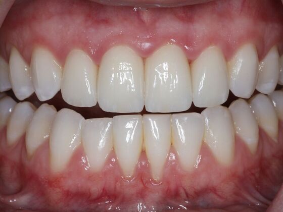 Dental Crowns Case 8 - After
