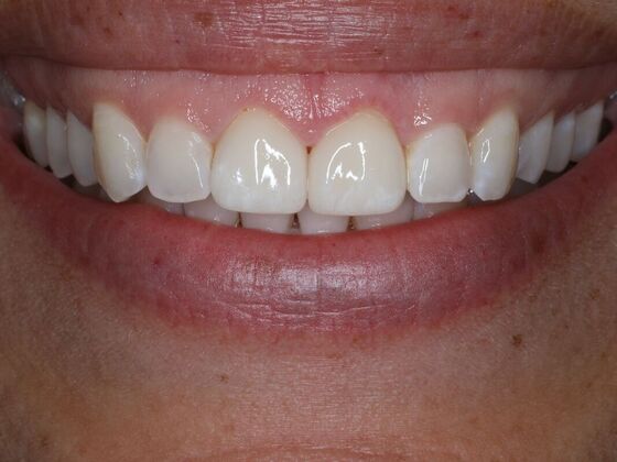 Dental Crowns Case 9 - After