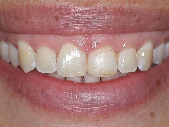 Dental Crowns Case 9 - Before
