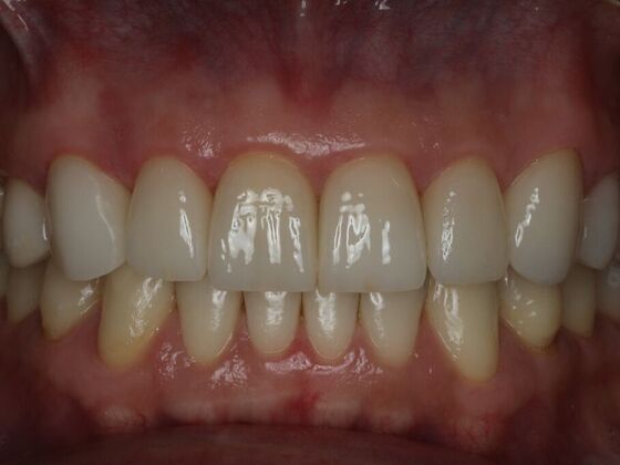 Dental Crowns Case 10 - After
