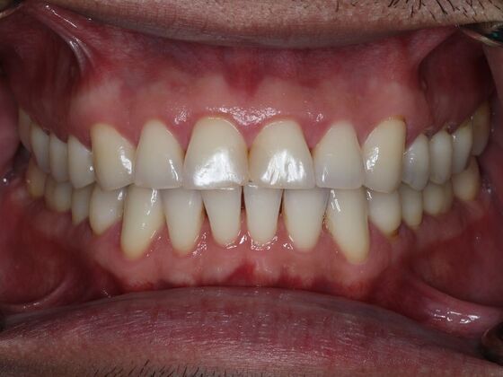 Dental Crowns Case 10 - Before