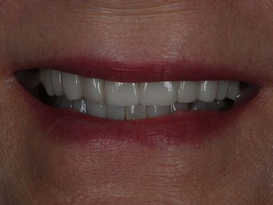 Dental Crowns Case 11 - After