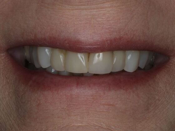 Dental Crowns Case 11 - Before