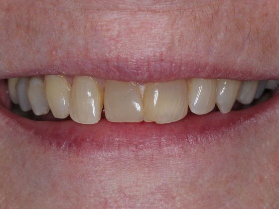 Dental Crowns Case 12 - Before