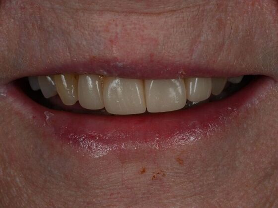 Dental Crowns Case 12 - After