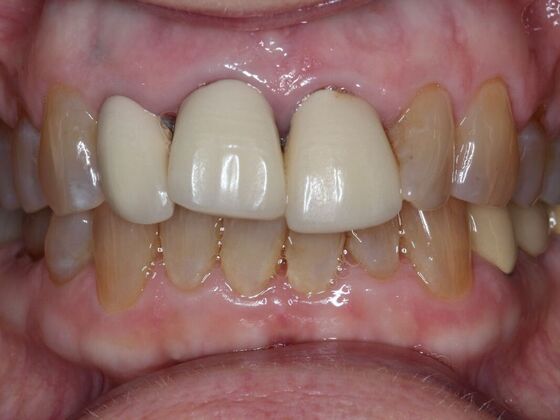 Dental Crowns Case 13 - Before