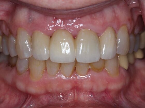 Dental Crowns Case 13 - After
